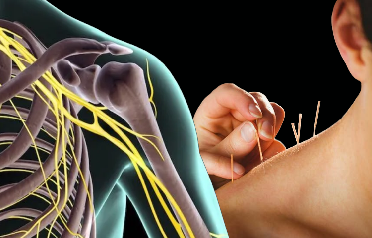 Điện mãng châm điều trị bệnh đám rối thần kinh cánh tay (Chứng nuy)